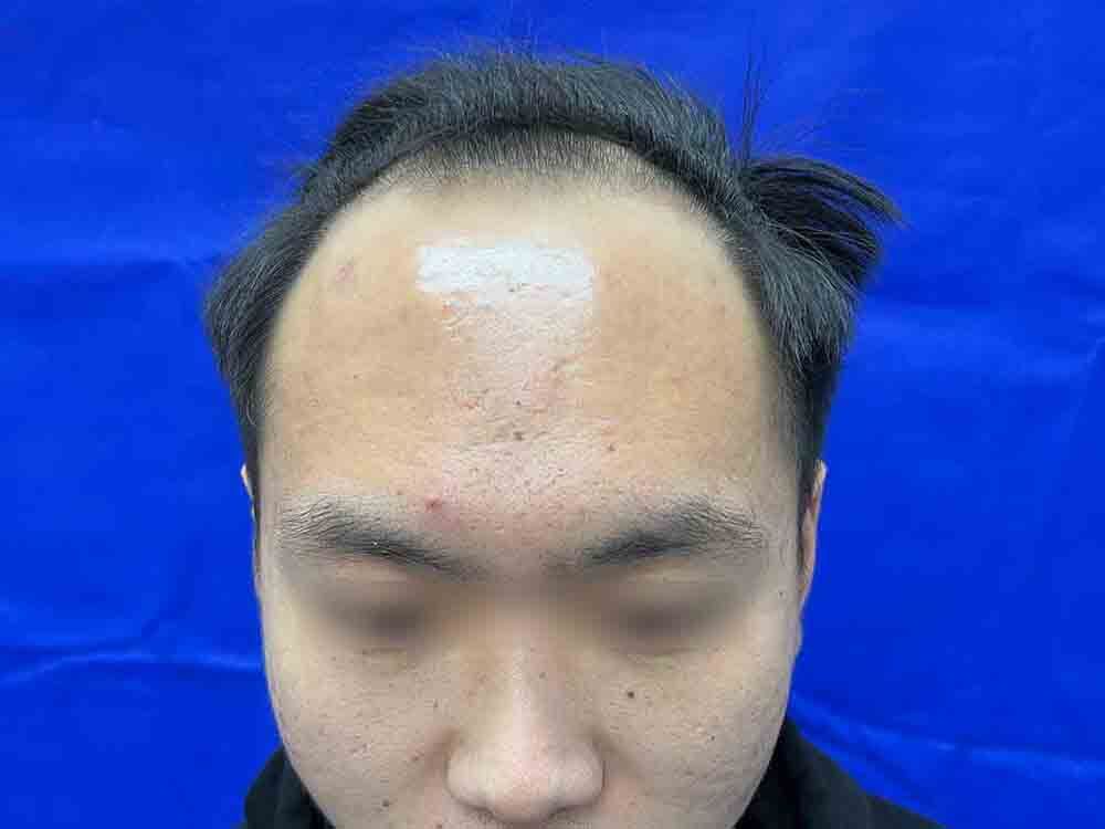 术前