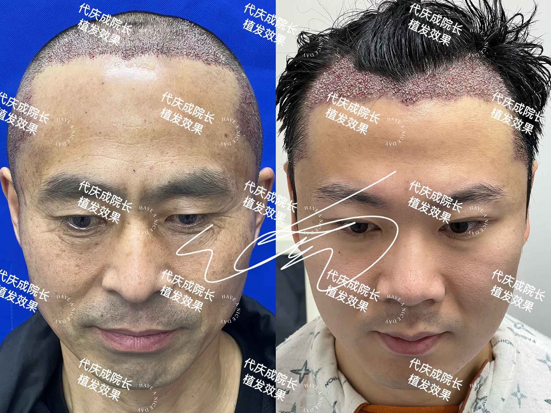 术后即刻