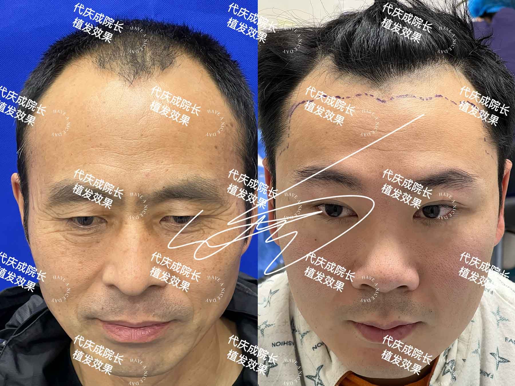 术前