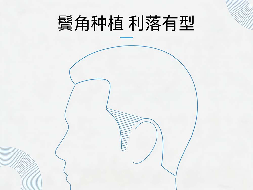 鬓角植发
