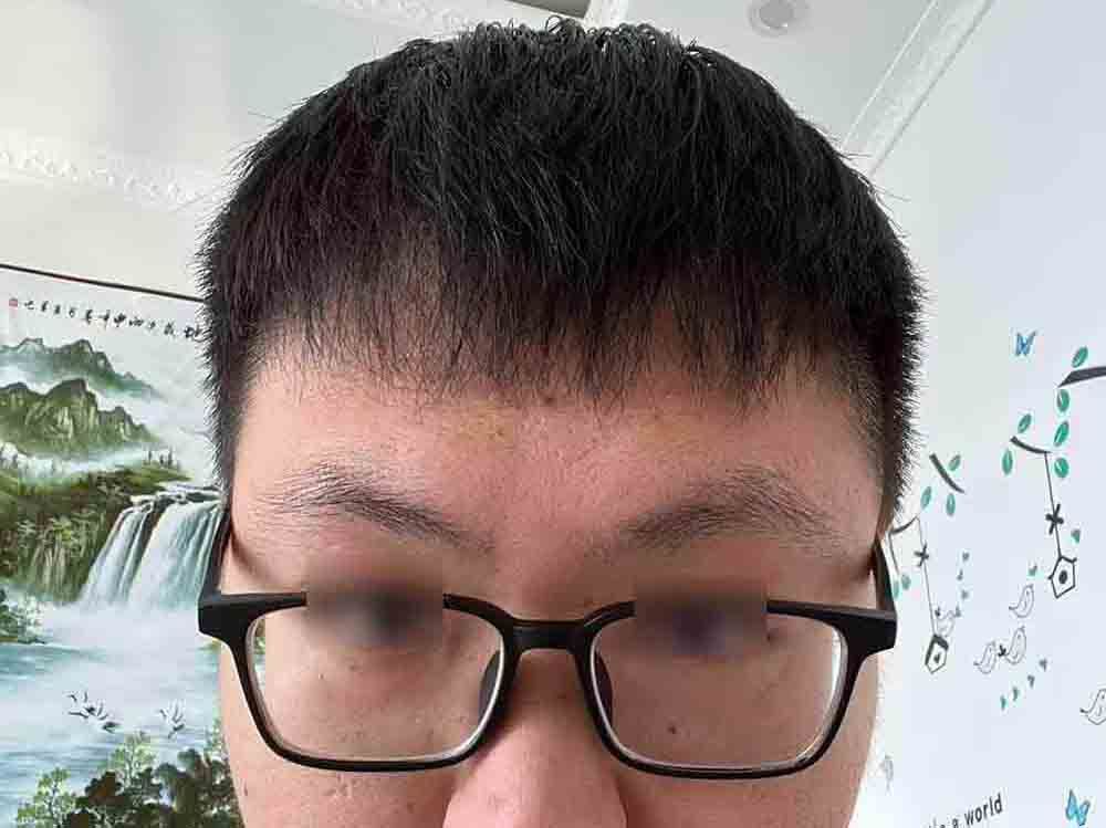 术后