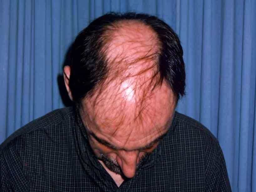 术前